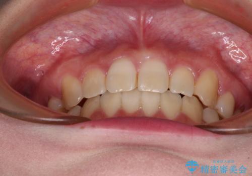 ディープバイトをインビザライン矯正で改善の治療後