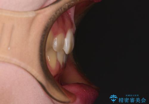 ディープバイトをインビザライン矯正で改善の治療後