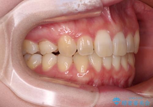 ディープバイトをインビザライン矯正で改善の治療後