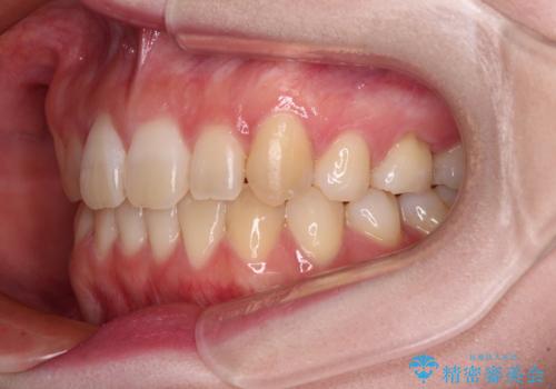 ディープバイトをインビザライン矯正で改善の治療後