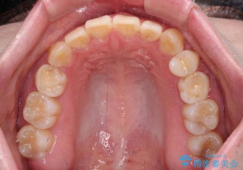 ディープバイトをインビザライン矯正で改善の治療後