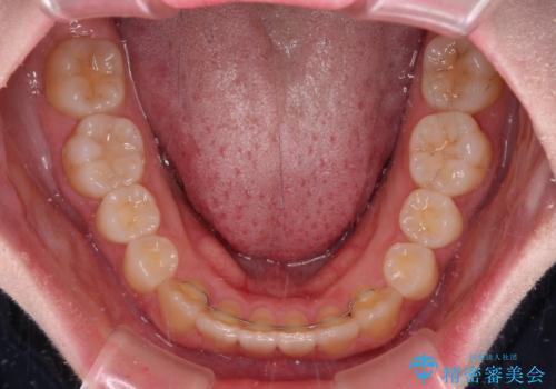 ディープバイトをインビザライン矯正で改善の治療後