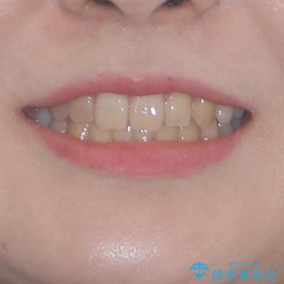 ディープバイトをインビザライン矯正で改善の治療後(顔貌)