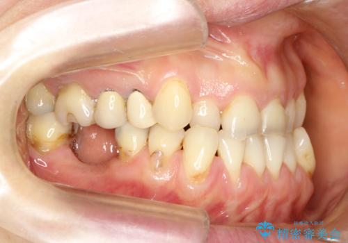 反対咬合や欠損を治療したい インビザライン矯正とオールセラミックブリッジの治療前