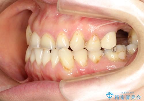 反対咬合や欠損を治療したい インビザライン矯正とオールセラミックブリッジの治療前