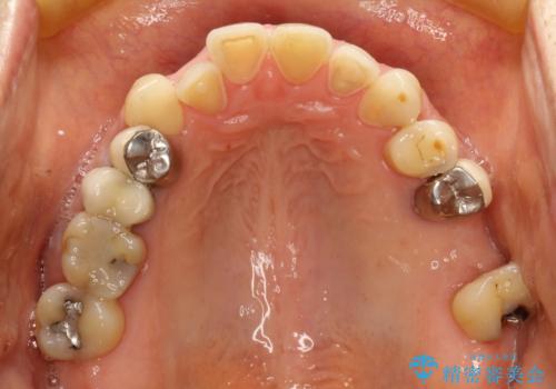 反対咬合や欠損を治療したい インビザライン矯正とオールセラミックブリッジの治療前