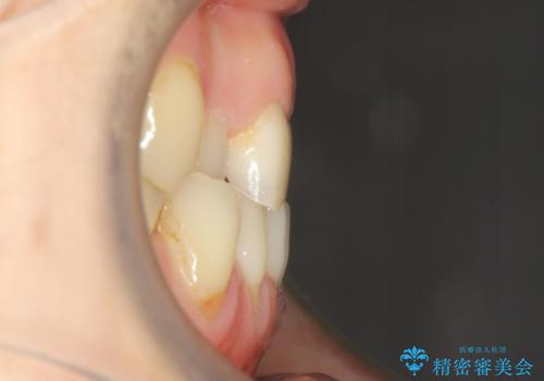 反対咬合や欠損を治療したい インビザライン矯正とオールセラミックブリッジの治療前