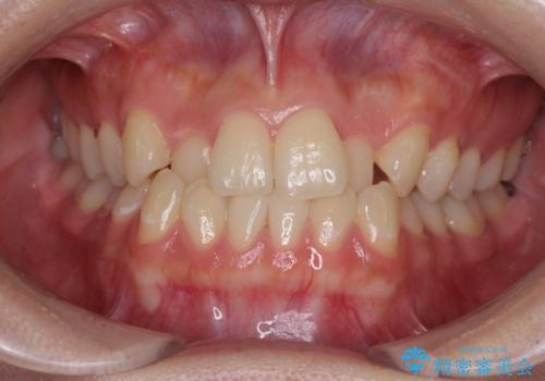 前歯のクロスバイトを短期間で解消　目立たないワイヤー矯正の症例 治療前