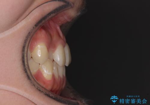 前歯のクロスバイトを短期間で解消 目立たないワイヤー矯正の治療前