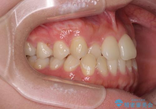 前歯のクロスバイトを短期間で解消 目立たないワイヤー矯正の治療前