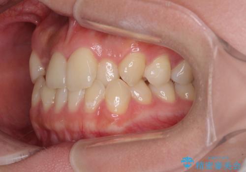 前歯のクロスバイトを短期間で解消　目立たないワイヤー矯正の治療前