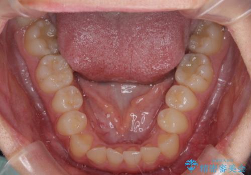 前歯のクロスバイトを短期間で解消 目立たないワイヤー矯正の治療前