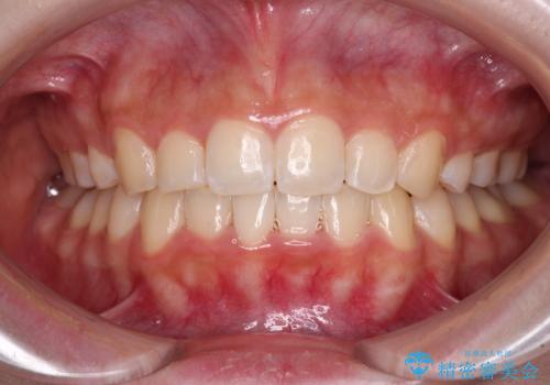 【モニター】八重歯とデコボコをスッキリきれいに ワイヤー装置での抜歯矯正