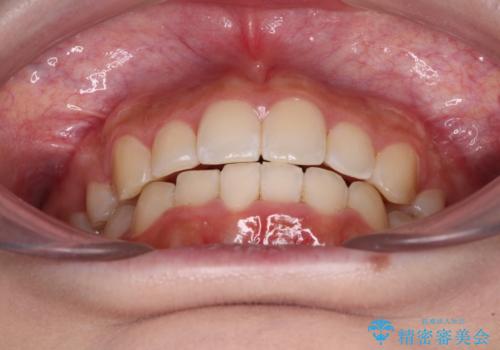 【モニター】八重歯とデコボコをスッキリきれいに ワイヤー装置での抜歯矯正の治療後