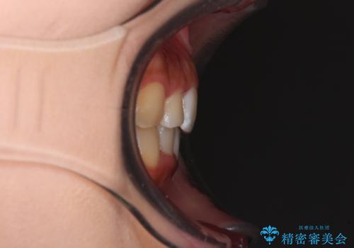 【モニター】八重歯とデコボコをスッキリきれいに ワイヤー装置での抜歯矯正の治療後