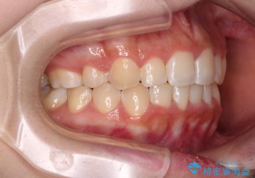 【モニター】八重歯とデコボコをスッキリきれいに ワイヤー装置での抜歯矯正の治療後