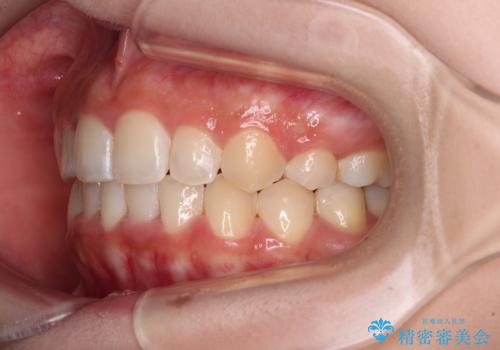【モニター】八重歯とデコボコをスッキリきれいに　ワイヤー装置での抜歯矯正の治療後