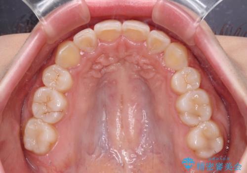 【モニター】八重歯とデコボコをスッキリきれいに ワイヤー装置での抜歯矯正の治療後