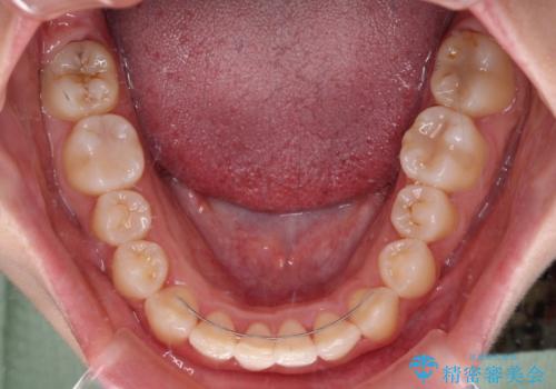 【モニター】八重歯とデコボコをスッキリきれいに ワイヤー装置での抜歯矯正の治療後