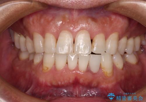 内側にある歯が干渉する　上顎前歯の部分矯正の症例 治療後