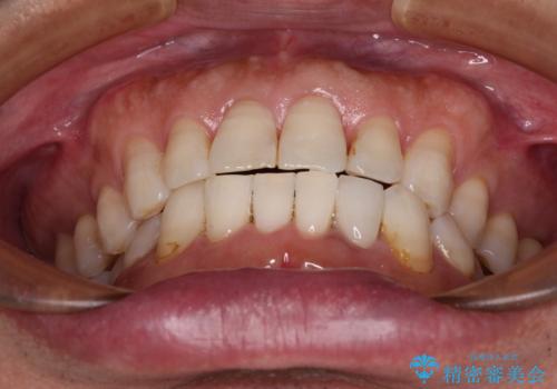 内側にある歯が干渉する 上顎前歯の部分矯正の治療後