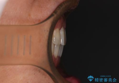 内側にある歯が干渉する 上顎前歯の部分矯正の治療後