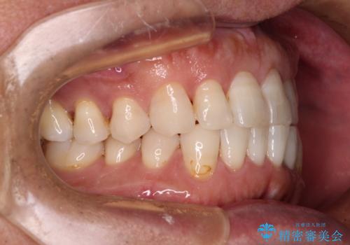 内側にある歯が干渉する　上顎前歯の部分矯正の治療後