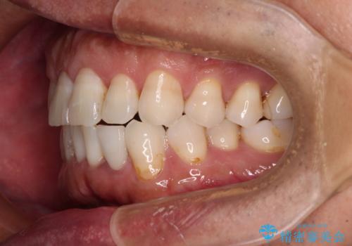 内側にある歯が干渉する　上顎前歯の部分矯正の治療後