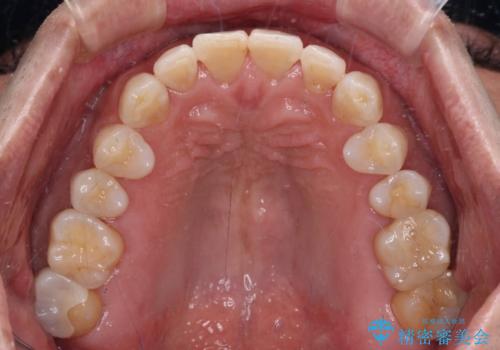 内側にある歯が干渉する 上顎前歯の部分矯正の治療後