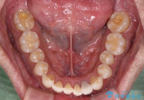 内側にある歯が干渉する 上顎前歯の部分矯正の治療後