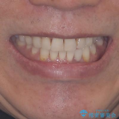 内側にある歯が干渉する　上顎前歯の部分矯正の治療後（顔貌）