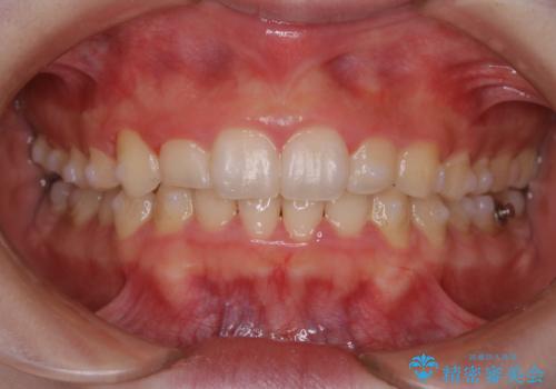 全体的にプラーク(歯垢)付着の患者様(PMTC30分コース)の症例 治療前