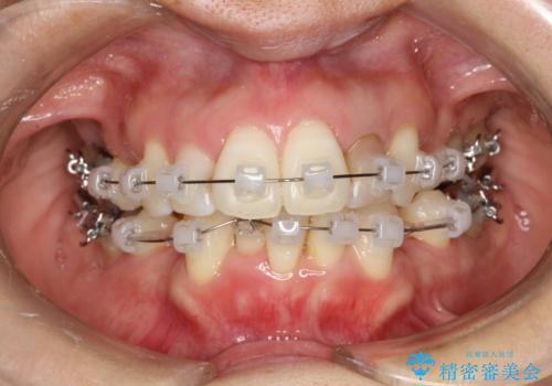 重度のガタガタと出っ歯をワイヤーによる抜歯矯正で整った歯並びへの治療中