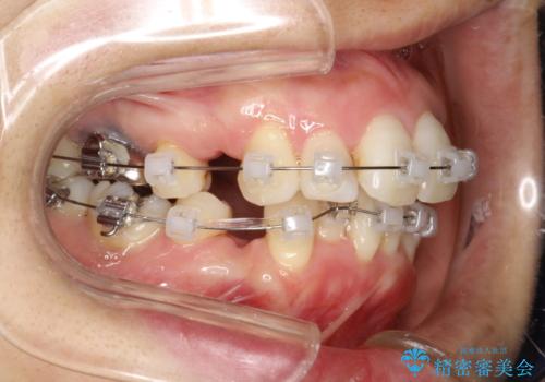 重度のガタガタと出っ歯をワイヤーによる抜歯矯正で整った歯並びへの治療中