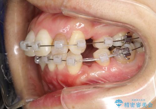 重度のガタガタと出っ歯をワイヤーによる抜歯矯正で整った歯並びへの治療中