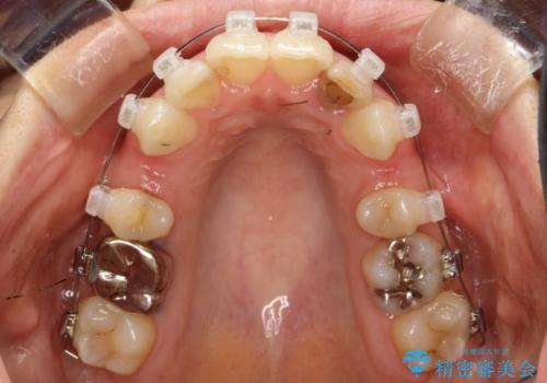 重度のガタガタと出っ歯をワイヤーによる抜歯矯正で整った歯並びへの治療中
