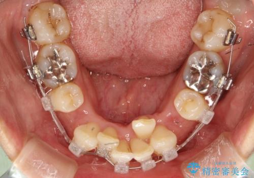 重度のガタガタと出っ歯をワイヤーによる抜歯矯正で整った歯並びへの治療中