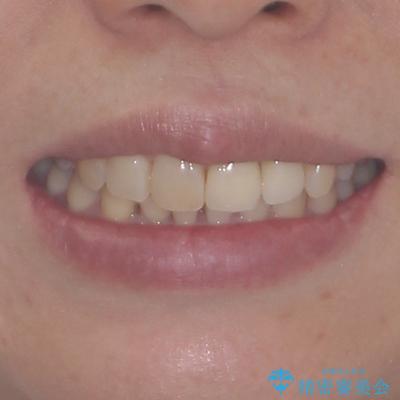 前歯のインプラント治療　折角なので矯正治療できれいな歯並びにの治療後（顔貌）
