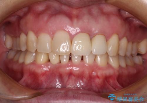 前歯のインプラント治療　折角なので矯正治療できれいな歯並びにの症例 治療後