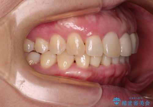 前歯のインプラント治療　折角なので矯正治療できれいな歯並びにの治療後