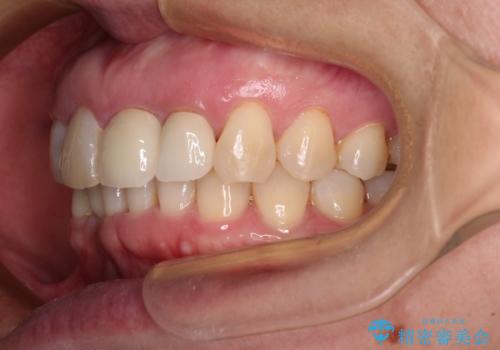 前歯のインプラント治療　折角なので矯正治療できれいな歯並びにの治療後