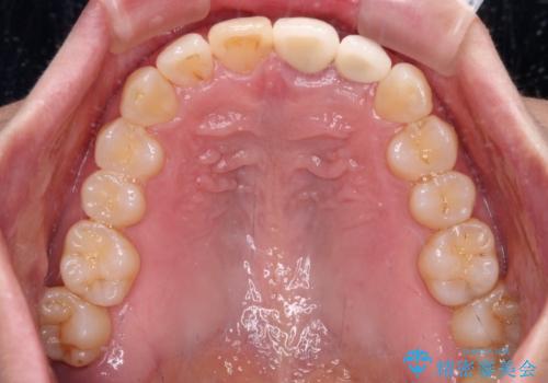 前歯のインプラント治療　折角なので矯正治療できれいな歯並びにの治療後