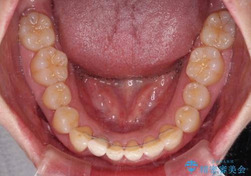 前歯のインプラント治療　折角なので矯正治療できれいな歯並びにの治療後