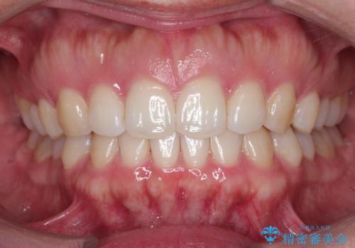 【前歯のガタガタが気になる】インビザライン症例の症例 治療後