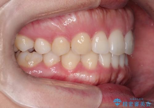 【前歯のガタガタが気になる】インビザライン症例の治療後