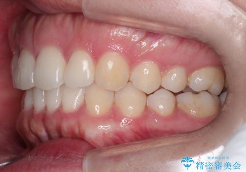 【前歯のガタガタが気になる】インビザライン症例の治療後