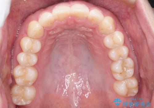 【前歯のガタガタが気になる】インビザライン症例の治療後