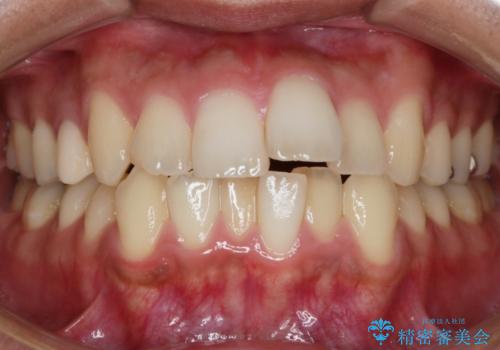 【非抜歯】インビザライン 出っ歯を治す!の症例 治療前