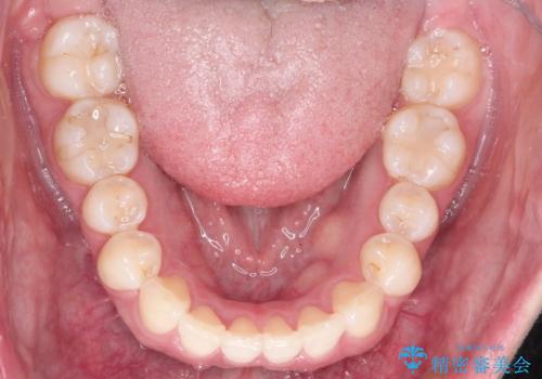 【前歯のガタガタが気になる】インビザライン症例の治療後