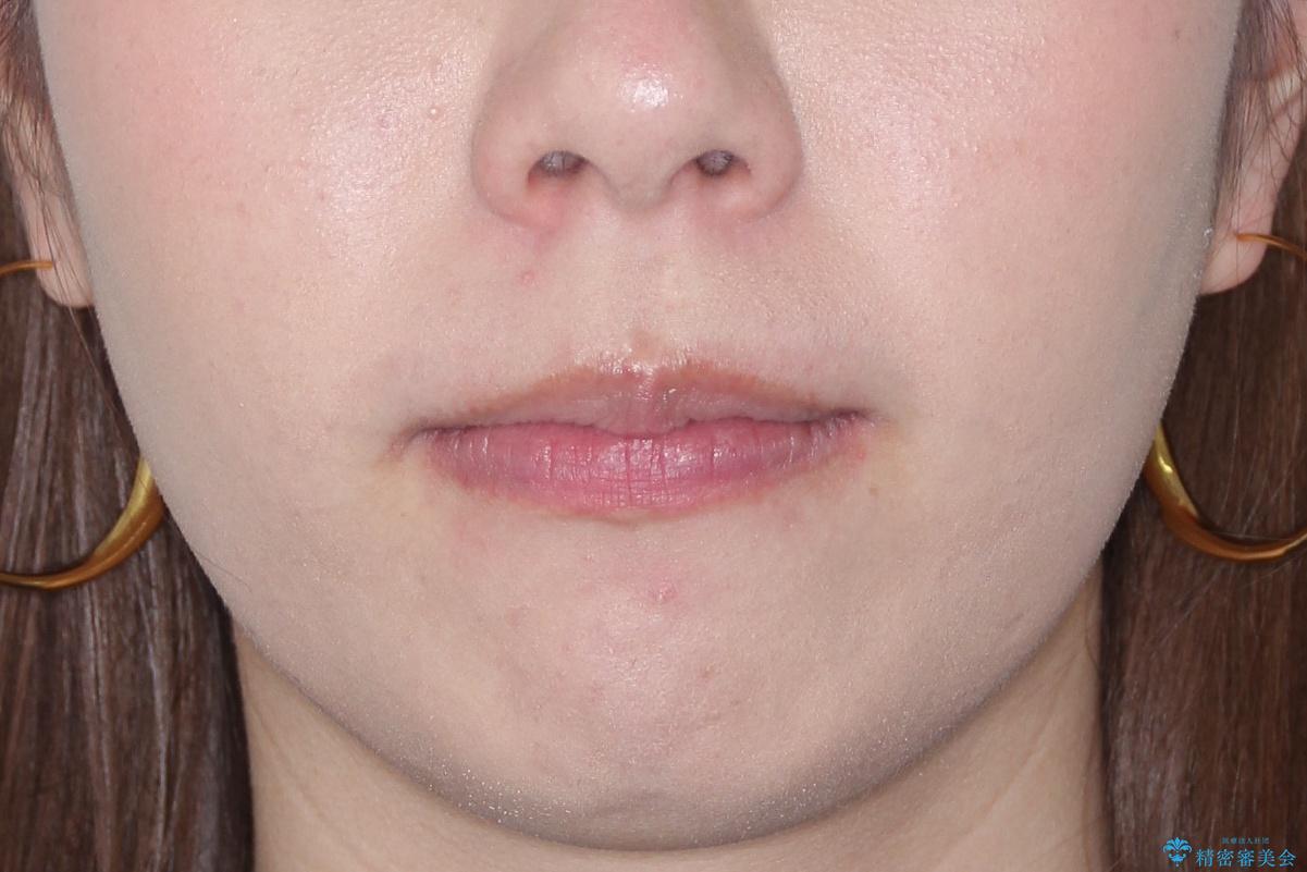 【前歯のガタガタが気になる】インビザライン症例の治療後(顔貌)